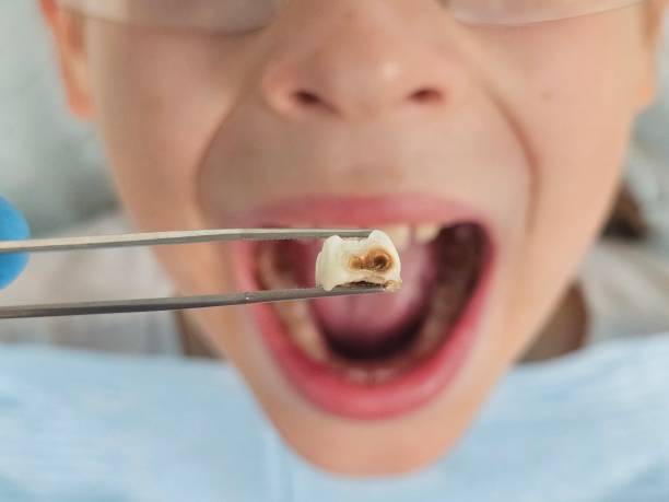 Best Emergency Dental Care for Broken or Chipped Teeth in Utica, OH
