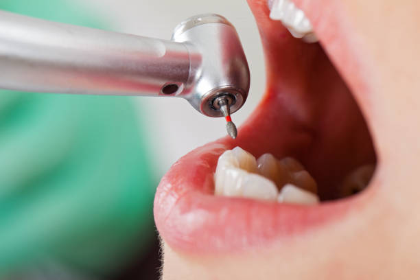 Best Emergency Tooth Extraction in Utica, OH